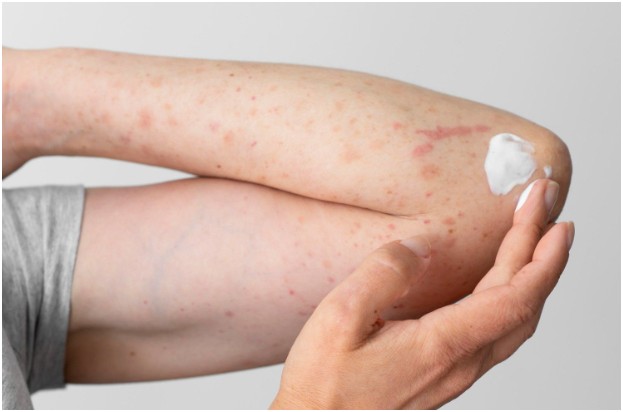 What Can Affect Road Rash Healing Time?