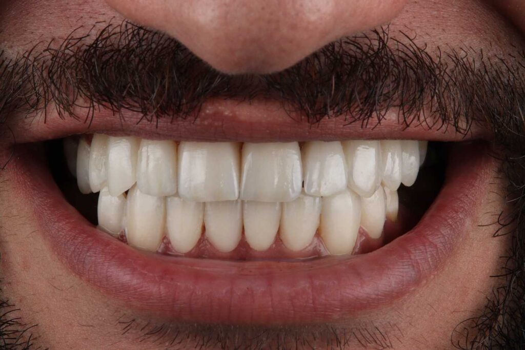 What Is Teeth Crowding