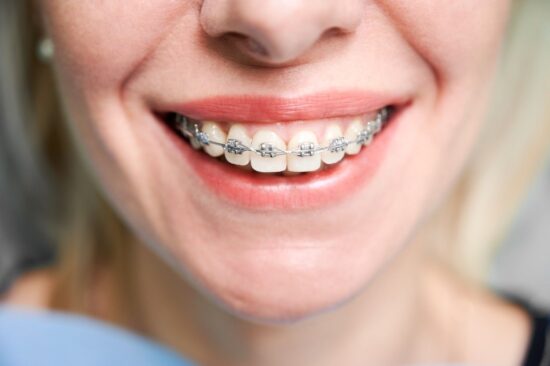 Braces in Kelowna remain a trusted solution for teens who need effective alignment support.