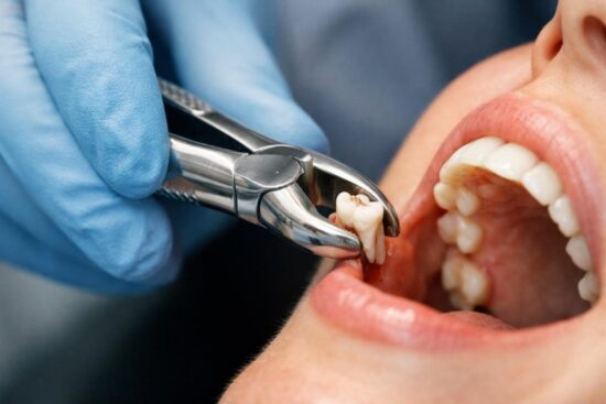 Precise Surgical Techniques for Tooth Removal