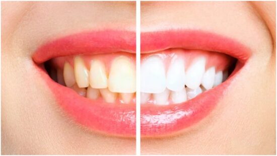 Teeth Whitening Advancements In Professional Care