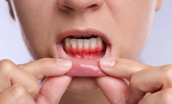 Bleeding or Swollen Gums