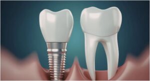 From Wisdom Teeth to Implants: Common Dental Surgeries Explained
