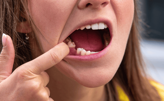 The Hidden Cost of Tooth Loss How Bone Melts Away