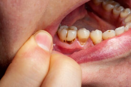 The Genetic Lottery of Dental Health
